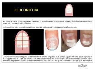 LEUCONICHIA


Nota anche con il nome di unghia di Bean, si manifesta con la comparsa a livello della lamina ungueale di
una o più chiazze di colore bianco.

La leuconichia oltre che nei soggetti con psoriasi può comparire in caso di ipoalbuminemia.




                  12,5%




La valutazione viene eseguita suddividendo la lamina ungueale in 8 settori uguali tra loro, dove ognuno di
essi rappresenta il 12,5% del totale. Se è interessato meno del 25% dell’area totale la manifestazione è lieve,
moderata se presente su una superﬁcie compresa tra il 25 e il 50%, grave se interessa più del 50% dell’unghia
 