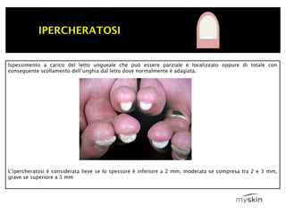 IPERCHERATOSI


Ispessimento a carico del letto ungueale che può essere parziale e localizzato oppure di totale con
conseguente scollamento dell’unghia dal letto dove normalmente è adagiata.




L’ipercheratosi è considerata lieve se lo spessore è inferiore a 2 mm, moderata se compresa tra 2 e 3 mm,
grave se superiore a 3 mm
 