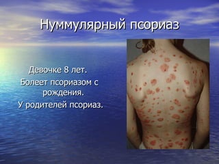 Нуммулярный псориаз Девочке 8 лет.  Болеет псориазом с рождения. У родителей псориаз. 