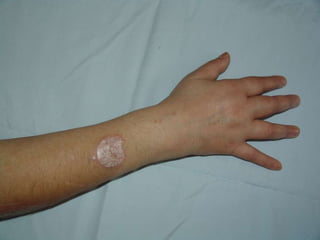 Ограниченный вульгарный псориаз. Псориатический артрит, синовиальная форма. Больной 53 года. Псориазом болеет 35 лет, ПА 6 лет. 