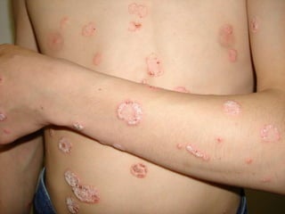 Кольцевидный псориаз ( psoriasis annularis seu orbicularis )  Мальчику 12 лет. Псориазом болен с рождения. Обострение после перелома правого предплечья  1,5 мес. назад. 