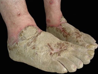 Ограниченный раздраженный псориаз Пациенту 32 года. Пориазом болеет 7 месяцев. По совету матери пользовался детским кремом.  Страдает хроническим алкоголизмом. 