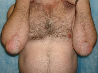 Дежурные бляшки Больному 48 лет. Бляшки на локтях  не разрешались  3,5 года.  