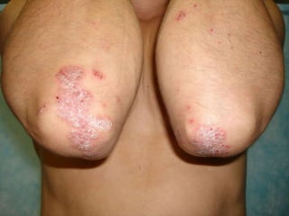 Ограниченный псориаз локтей Больному 43 года.  Заболел  псориазом  7 мес. назад.  