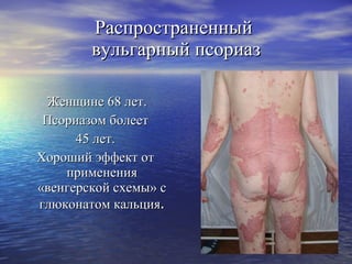 Распространенный  вульгарный псориаз Женщине 68 лет. Псориазом болеет 45 лет.  Хороший эффект от применения «венгерской схемы» с глюконатом кальция . 