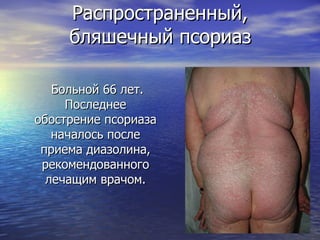 Распространенный,  бляшечный псориаз   Больной 66 лет. Последнее обострение псориаза началось после приема диазолина, рекомендованного лечащим врачом. 