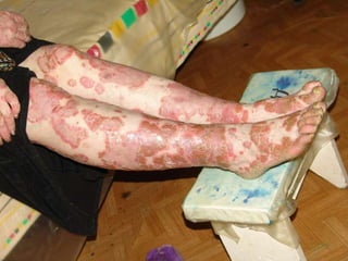 Распространенный, бляшечный, экссудативный псориаз с поражением ногтевых пластинок. Больной 33 года. Обострение заболевания после криминального аборта, на фоне хр. алкоголизма. 