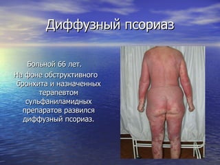 Диффузный псориаз Больной 66 лет. На фоне обструктивного бронхита и назначенных терапевтом сульфаниламидных препаратов развился диффузный псориаз. 