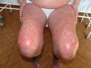 Генерализованный пустулезный псориаз (тип Цумбуша) Пациентке 56 лет.  Болела 3 года. Начиналось заболевание по типу акродерматита Аллопо с поражения ногтевых фаланг кистей и стоп. Самолечение закончилось развитием синдрома Иценко-Кушинга, слепотой, инфарктом миокарда и летальным исходом.  