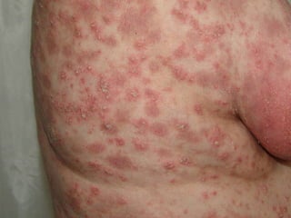 Генерализованный пустулезный псориаз (тип Цумбуша) Женщине 58 лет.  Болеет 1 год. После назначения бисептола развилась настоящая картина. Фотография сделана на фоне  120 мг. преднизолона в/м в сутки. 