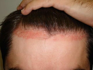 Псориаз волосистой части головы «Псориатическая корона» У больного псориатическим артритом правого коленного сустава 