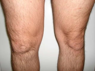 Псориатический артрит Мужчине 38 лет. У него имелась типичная «псориатическая корона». Правый коленный сустав болел 2 мес. То, что это псориатический артрит не поверил.  Обратился к хирургу в поликлинику. После пункции сустава развился псориатический полиартрит и распространённый псориаз. 