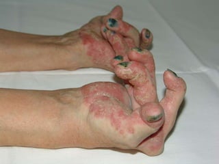 Псориатический артрит Деформирующий  ПА с развитием анкилозов и артрозов суставов кистей у больной генерализованным пустулезным псориазом.  3 года назад она была пианисткой. 