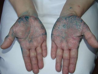 Пустулезный псориаз ладоней и подошв  (тип Барбера) Женщине 48 лет. Болеет 1 год. Злостная курильщица. 