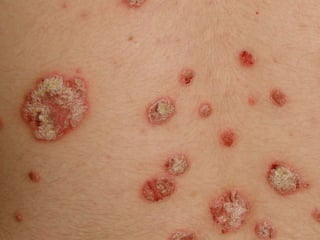 Экссудативный псориаз (прогрессирующий период) Больному 17 лет. Болен псориазом с марта 2006 г. Состояние после терапии в одном из платных стационаров  г. СПб.  