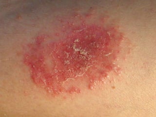 Экссудативный  или  экземоподобный псориаз    Женщине 45 лет.  Псориазом  страдает 6 лет. Последнее обострение началось  2 нед. назад после смерти мужа.  