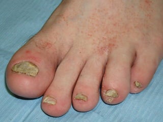Псориаз ногтевых пластинок Больному 32 года. Поражены все ногти стоп и кистей.  При микроскопии и посеве дрожжи и нити мицелия не обнаружены. 