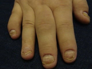 Псориаз ногтевых пластинок Больному 48 лет. Диагноз: распространённый экссудативный псориаз, осложнённый псориатическим полиартритом. Поражены псориазом все ногти стоп и кистей.  При микроскопии и посеве дрожжи и нити мицелия  дважды не обнаружены.  Из анамнеза выяснено, что 1,5 г. назад ему были удалены н/пл стоп без анестезии и без проведения лабораторных анализов в одном из  КВД СПб.  