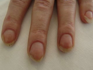 Псориаз ногтевых пластинок Симптом «наперстка»  и  «масляного  пятна» 