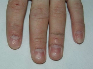 Псориаз ногтевых пластинок Симптом  «наперстка» 