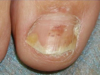 Псориаз ногтевых пластинок Симптом  «масляного пятна»,  онихолизис и  полосовидные кровоизлияния. 