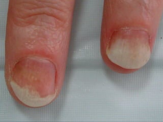 Псориаз  ногтевых пластинок Едва заметен симптом  «масляного пятна»  и  отчётливо выражен онихолизис  