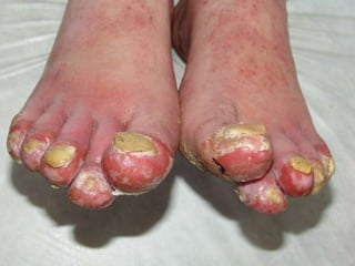 ДИФФЕРЕНЦИАЛЬНАЯ ДИАГНОСТИКА Пациенту 42 г.  Болен 2,5 месяца. Диагноз: акродерматит Аллопо 