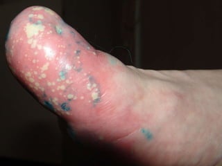 ДИФФЕРЕНЦИАЛЬНАЯ ДИАГНОСТИКА Пациенту 62 г.  Болеет более 6 лет. Диагноз: акродерматит Аллопо 