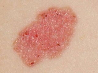 ДИФФЕРЕНЦИАЛЬНАЯ ДИАГНОСТИКА Больная 47 лет.  Страдает псориазом 15 лет. Было выявлено сопутствующее заболевание:  базальноклеточный рак кожи. 