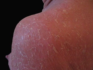 ДИФФЕРЕНЦИАЛЬНАЯ ДИАГНОСТИКА Больной 48 лет.  Кожная Т-клеточная лимфома, эритродермическая форма (эксфолиативная эритродермия). Проводилась дифференциальная диагностика, в том числе, с псориатической эритродермией. 