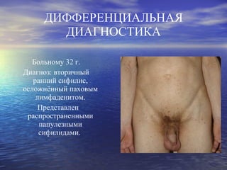 ДИФФЕРЕНЦИАЛЬНАЯ ДИАГНОСТИКА Больному 32 г. Диагноз: вторичный ранний сифилис, осложнённый паховым лимфаденитом. Представлен распространенными папулезными сифилидами.  