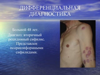 ДИФФЕРЕНЦИАЛЬНАЯ ДИАГНОСТИКА Больной 48 лет. Диагноз: вторичный рецидивный сифилис. Представлен псориазиформными сифилидами. 