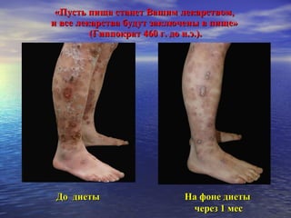 «Пусть пища станет Вашим лекарством,  и все лекарства будут заключены в пище»  (Гиппократ 460 г. до н.э.). До  диеты  На фоне диеты    через 1 мес 