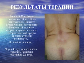 РЕЗУЛЬТАТЫ ТЕРАПИИ Больной 72 г. Болеет псориазом 38 лет. Врач рентгенолог. Диагноз: ограниченный застарелый бляшечный  псориаз, псориаз крупных складок. Псориатический артрит средней степени активности.  До начала лечения. Через 43 сут. после начала терапии. Ремиссия составила 2,5 года. 
