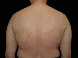 РЕЗУЛЬТАТЫ ТЕРАПИИ Больному 48 лет. Распространённый, раздражённый псориаз.  Летняя форма.  Результат самолечения после использования УФО. Через 57 сут. терапии. 