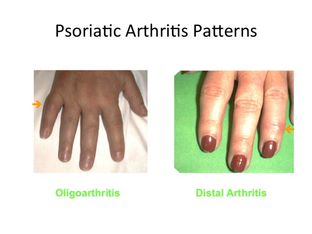 Psoriatic arthritis clinical features &amp; epidemiology.