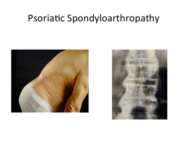Psoriatic arthritis clinical features & epidemiology.