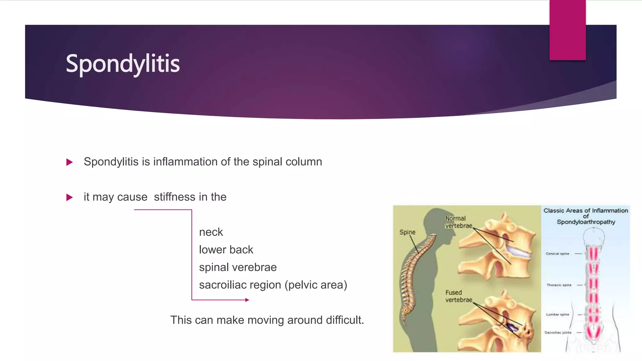 Spondylitis
 Spondylitis is inflammation of the spinal column
 it may cause stiffness in the
neck
lower back
spinal verebrae
sacroiliac region (pelvic area)
This can make moving around difficult.
 