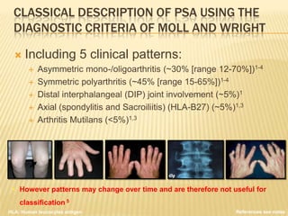 CLASSICAL DESCRIPTION OF PSA USING THE
DIAGNOSTIC CRITERIA OF MOLL AND WRIGHT


Including 5 clinical patterns:







Asymmetric mono-/oligoarthritis (~30% [range 12-70%])1-4
Symmetric polyarthritis (~45% [range 15-65%])1-4
Distal interphalangeal (DIP) joint involvement (~5%)1
Axial (spondylitis and Sacroiliitis) (HLA-B27) (~5%)1,3
Arthritis Mutilans (<5%)1,3

• However patterns may change over time and are therefore not useful for
classification 5
HLA: Human leucocytes antigen

References see notes

 
