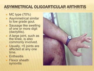 ASYMMETRICAL OLIGOARTICULAR ARTHRITIS












MC type (70%)
Asymmetrical similar
to low grade gout.
Sausage like swelling
of one or more digit
(dactylitis).
A large joint, such as
the knee, is also
commonly involved.
Usually, <5 joints are
affected at any one
time.
Enthesitis
Flexor sheath
synovitis

 
