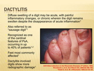 DACTYLITIS
• Diffuse swelling of a digit may be acute, with painful
inflammatory changes, or chronic wherein the digit remains
swollen despite the disappearance of acute inflammation1
• Also referred to as
―sausage digit‖1
• Recognized as one
of the cardinal
features of PsA,
occurring in up
to 40% of patients1,2
• Feet most commonly
affected1
• Dactylitis involved
digits show more
radiographic damage1

ACR Slide Collection on the Rheumatic Diseases; 3rd edition. 1994.
1Brockbank J, et al. Ann Rheum Dis. 2005;64:188–190.
2Veale D, et al. Br J Rheumatol. 1994;33:133–38.

 