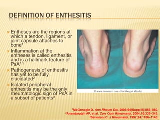 DEFINITION OF ENTHESITIS
 Entheses

are the regions at
which a tendon, ligament, or
joint capsule attaches to
bone1
 Inflammation at the
entheses is called enthesitis
and is a hallmark feature of
PsA1,2
 Pathogenesis of enthesitis
has yet to be fully
elucidated2
 Isolated peripheral
enthesitis may be the only
rheumatologic sign of PsA in
a subset of patients3
1McGonagle

D. Ann Rheum Dis. 2005;64(Suppl II):ii58–ii60.
2Anandarajah AP, et al. Curr Opin Rheumatol. 2004;16:338–343.
3Salvarani C. J Rheumatol. 1997;24:1106–1140.

 