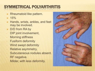 SYMMETRICAL POLYARTHRITIS




-

-

-

Rheumatoid like pattern.
15%
Hands, wrists, ankles, and feet
may be involved.
D/D from RA by
DIP joint involvement,
Morning stiffness
Fusiform deformity
Wind swept deformity
Relative asymmetry,
Subcutaneous nodules absent.
RF negative.
Milder, with less deformity.

 