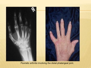 Psoriatic arthritis involving the distal phalangeal joint.

 