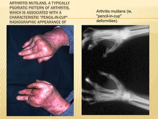 ARTHRITIS MUTILANS, A TYPICALLY
PSORIATIC PATTERN OF ARTHRITIS,
WHICH IS ASSOCIATED WITH A
CHARACTERISTIC "PENCIL-IN-CUP"
RADIOGRAPHIC APPEARANCE OF
DIGITS.

Arthritis mutilans (ie,
"pencil-in-cup"
deformities).

 