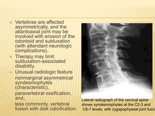 




-

-

Vertebrae are affected
asymmetrically, and the
atlantoaxial joint may be
involved with erosion of the
odontoid and subluxation
(with attendant neurologic
complications).
Therapy may limit
subluxation-associated
disability.
Unusual radiologic feature
nonmarginal asymmetrical
syndesmophytes
(characteristic),
paravertebral ossification,
and,
less commonly, vertebral
fusion with disk calcification.

Lateral radiograph of the cervical spine
shows syndesmophytes at the C2-3 and
C6-7 levels, with zygapophyseal joint fusio

 