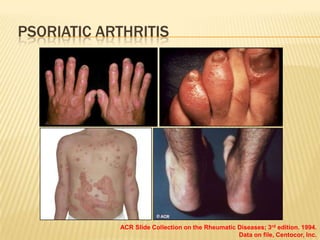 PSORIATIC ARTHRITIS

ACR Slide Collection on the Rheumatic Diseases; 3rd edition. 1994.
Data on file, Centocor, Inc.

 