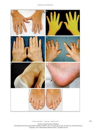 n engl j med 376;10 nejm.org March 9, 2017 959
Psoriatic Arthritis
A B
DC
FE
G
The New England Journal of Medicine
Downloaded from nejm.org by RAJIV KUMAR on March 9, 2017. For personal use only. No other uses without permission.
Copyright © 2017 Massachusetts Medical Society. All rights reserved.
 