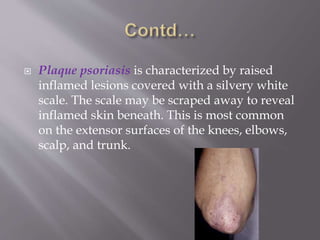  Plaque psoriasis is characterized by raised
inflamed lesions covered with a silvery white
scale. The scale may be scraped away to reveal
inflamed skin beneath. This is most common
on the extensor surfaces of the knees, elbows,
scalp, and trunk.
 