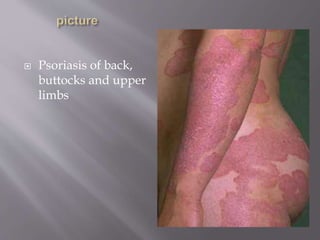 Psoriasis of back,
buttocks and upper
limbs
 